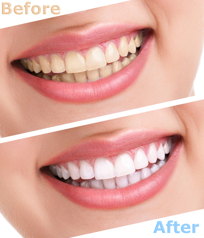bleaching teeth treatment , close up, isolated on white, before and after